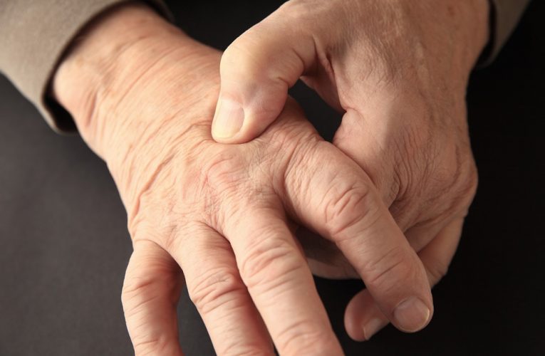 Rheumatoid Arthritis and Osteoarthritis